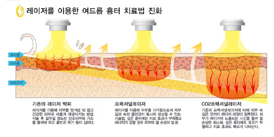 CO2 프랙셔널레이저