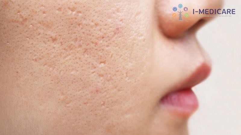 Cồi mụn có tự hết không? Vì sao không nên tự nặn tại nhà - ảnh 3