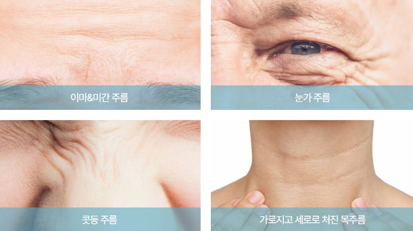 이마/미간/눈가주름