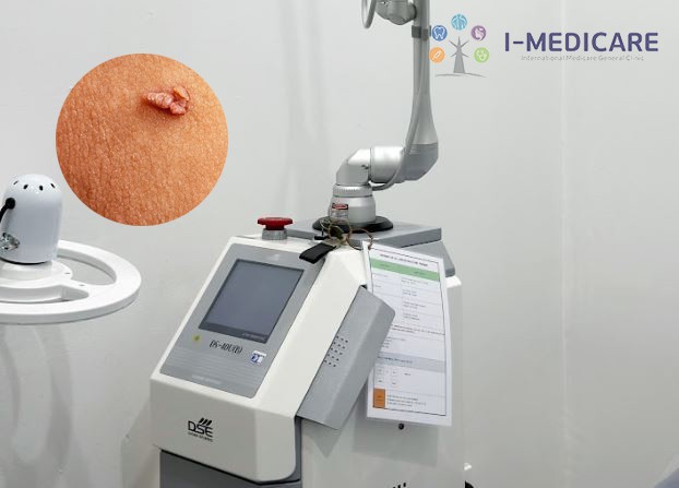Điều trị sùi mào gà bằng Laser CO2