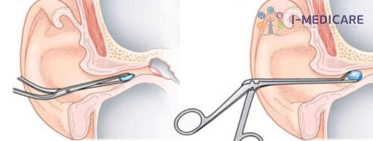 Lấy dị vật tai (Gây tê)
