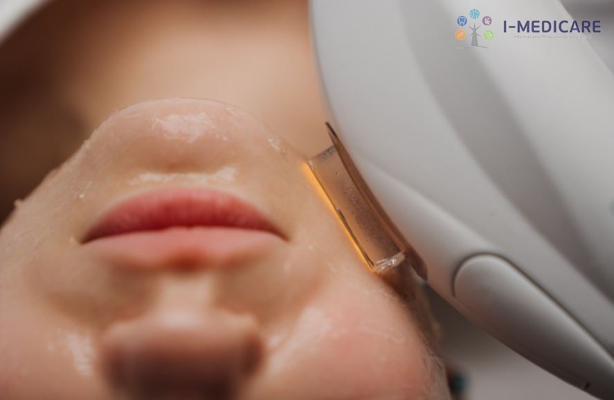 Điều trị trứng cá bằng IPL