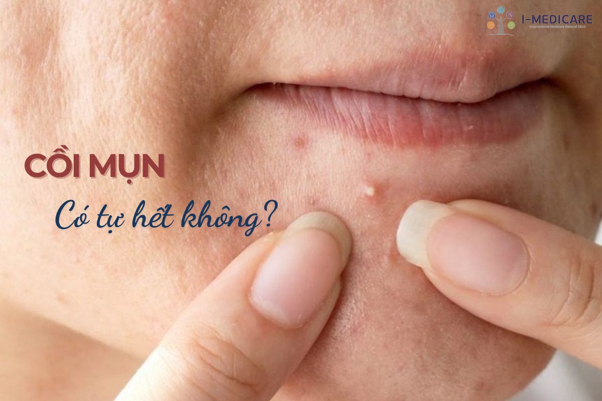 Cồi mụn có tự hết không? Vì sao không nên tự nặn tại nhà