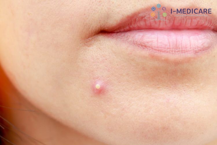 Cồi mụn có tự hết không? Vì sao không nên tự nặn tại nhà - ảnh 1