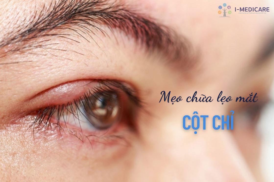 Mẹo chữa lẹo mắt cột chỉ: Hiệu quả thật hay rủi ro tiềm ẩn?