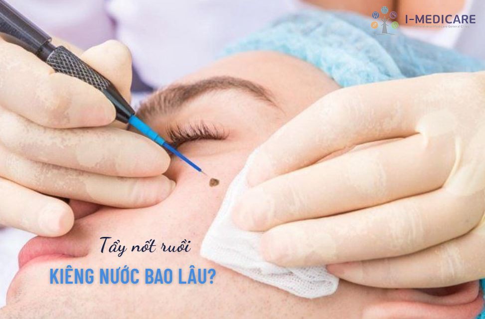Tẩy nốt ruồi kiêng nước bao lâu? 3 mốc thời gian bạn cần ghi nhớ